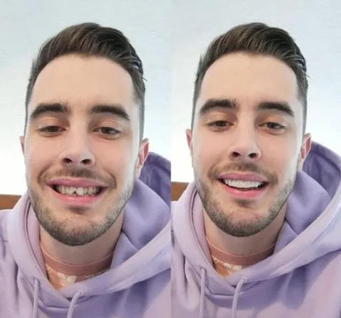 Tannfiner for perfekt smil 2