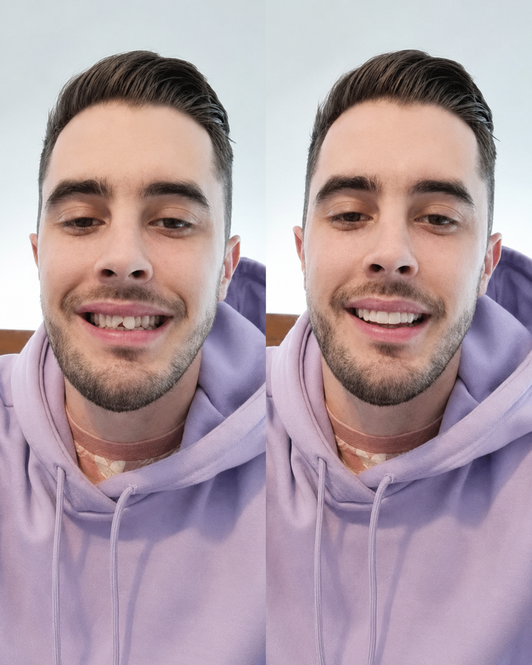 Tannfiner for perfekt smil